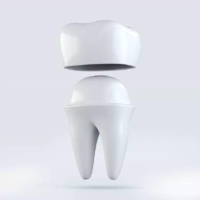 dental-caps-placement-at-best-dental-clinic-in-hyderabad-drjaydev