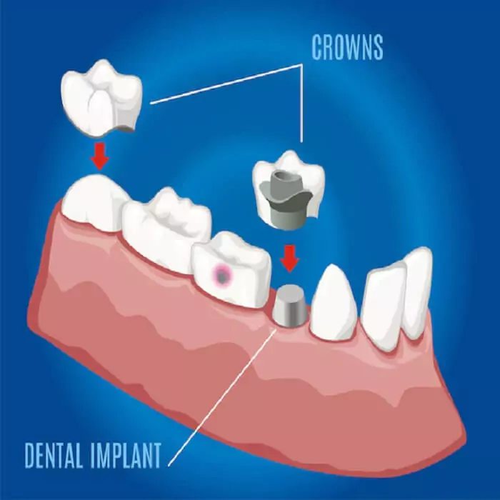placement-of-crowns-over-implants-procedure