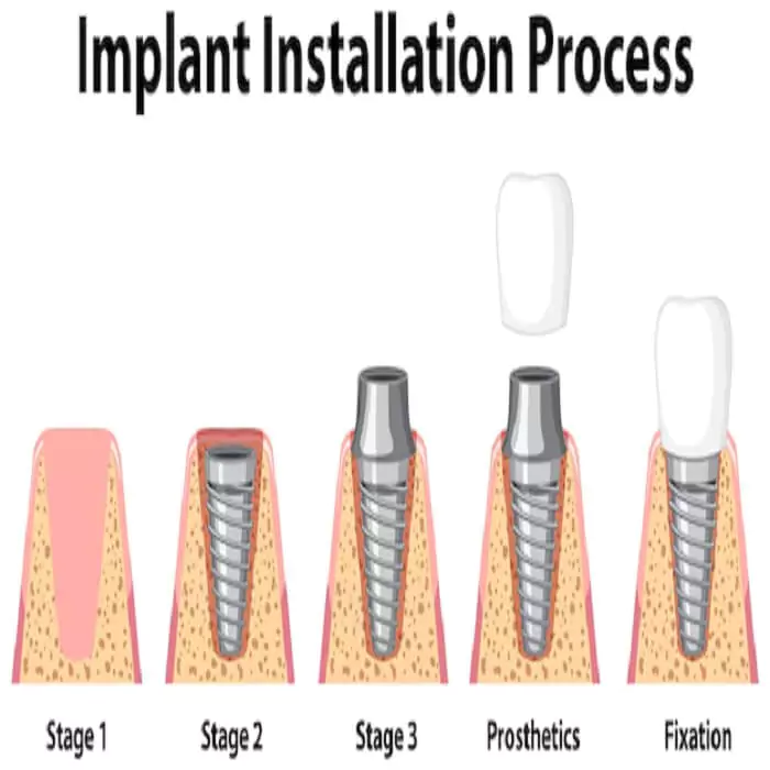 step-by-step-procedure-of-dental-implant-placement-in-best-dental-hospital-hyderabad