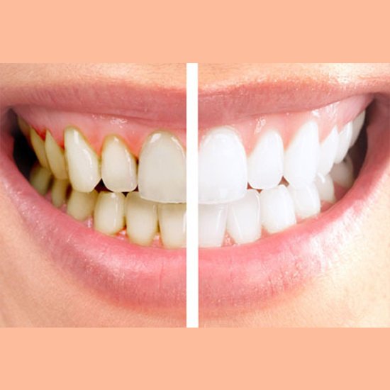 teeth-polishing-service-by-best-dentists-in-hyderabad