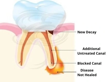 internal-structure-of-infected-tooth-for-re-root-canal