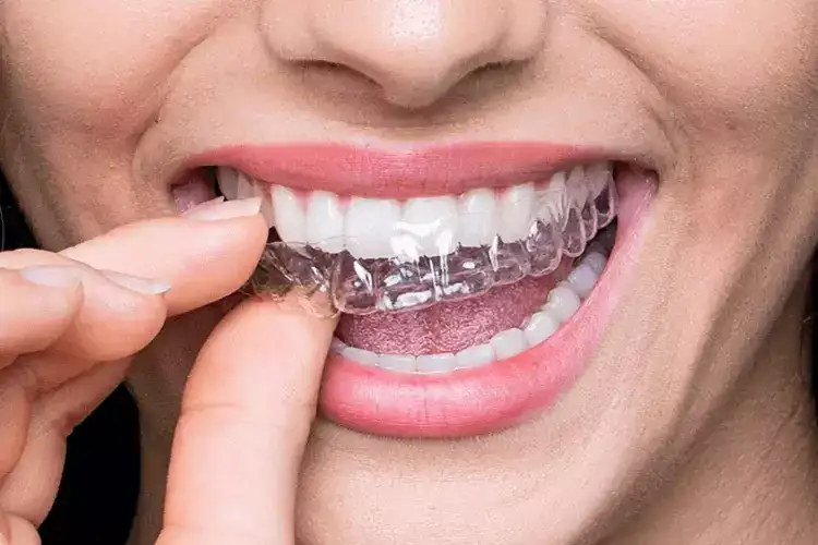 best-dental-braces-teeth-aligners-treatment-in-hyderabad
