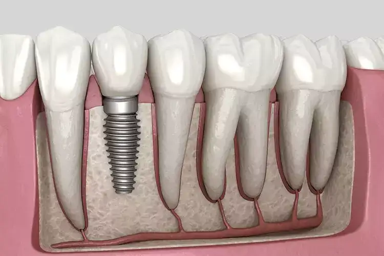 best-dental-implants-in-hyderabad