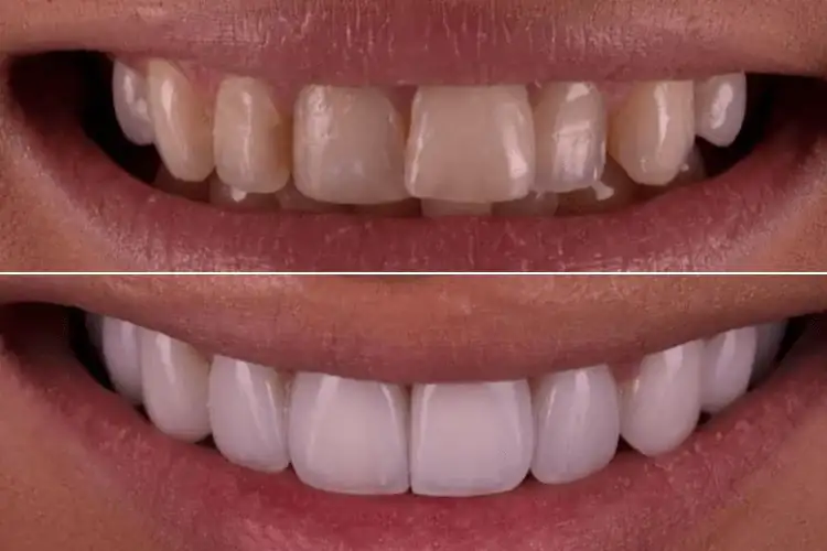 smile-difference-before-after-dental-veneers