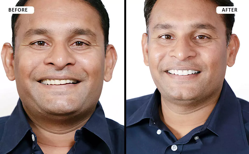 smile-designing-before-and-after-at-drjaydev-dental-clinic