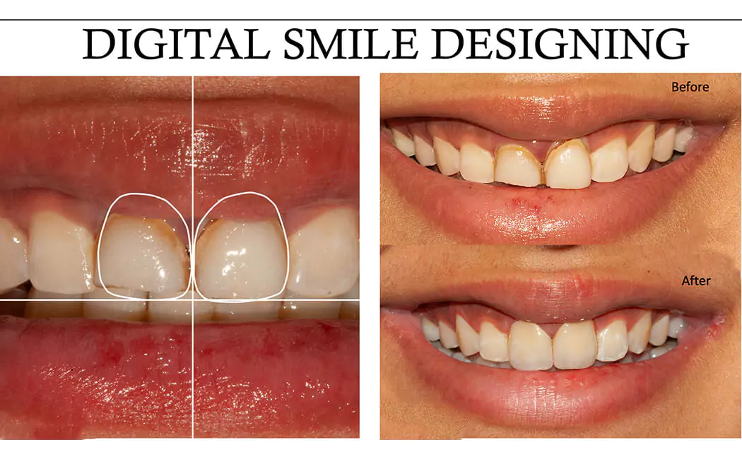digital-smile-designing-process-at-drjaydev-dental-clinic-hyderabad
