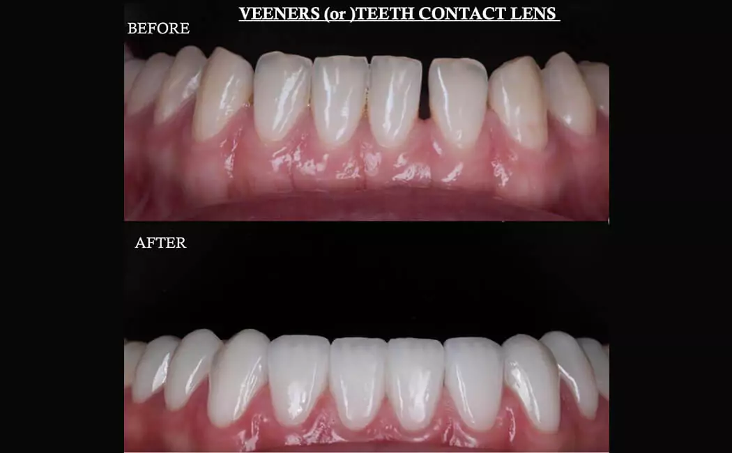before-after-of-dental-caps-veneers-treatment-at-drjaydev-dental-clinic-hyderabad