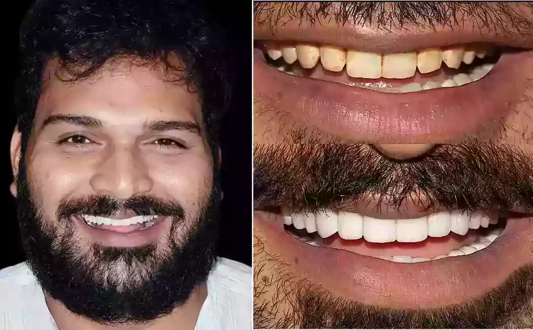 smile-look-before-after-dental-caps-veneers-treatment-at-drjaydev-dental-clinic-hyderabad